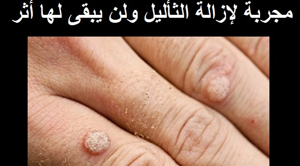 مجربة لإزالة الثأليل ولن يبقى لها أثر